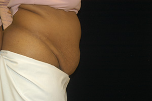 Abdominoplasty 5c